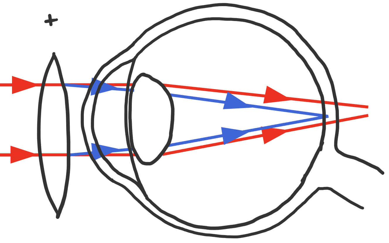 Lichtstralen bij een verziend oog (convergeren na het netvlies in het rood) en de correctie met een positieve lens (convergeren eerst op hoornvlies, dan convergeren op het netvlies in het blauw).