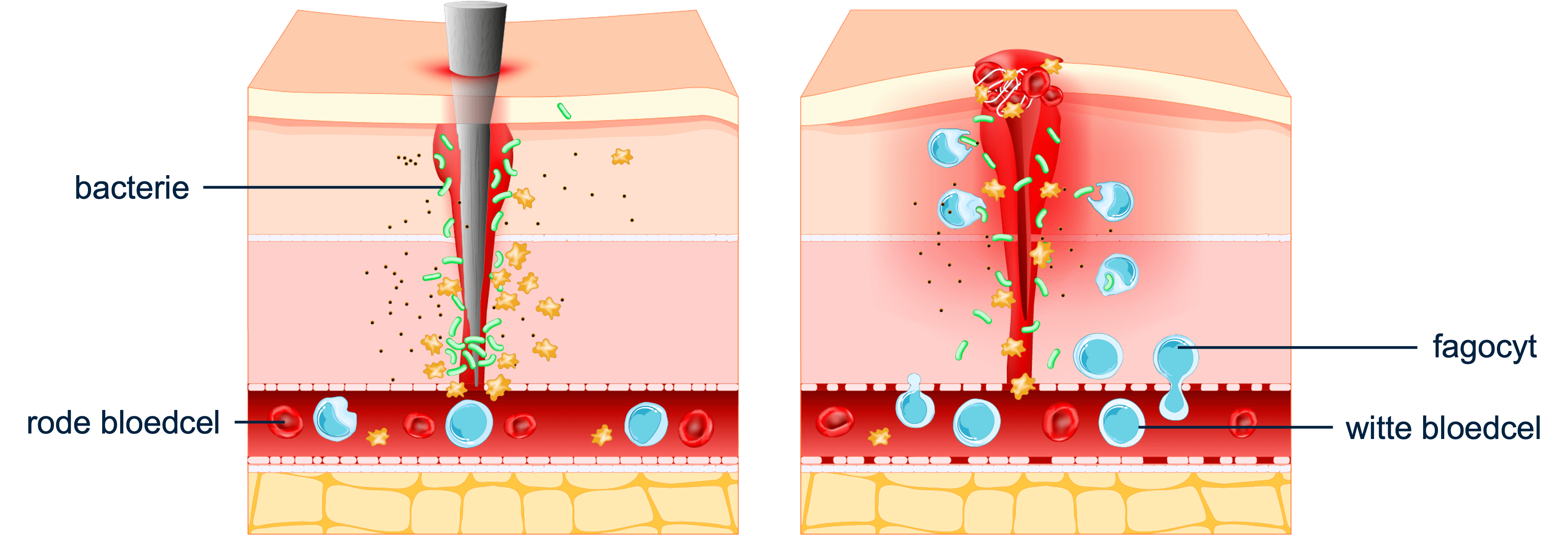 Overzicht van fagocyten die bacteriën herkennen van een splinter en ze opslokken en verteren.
