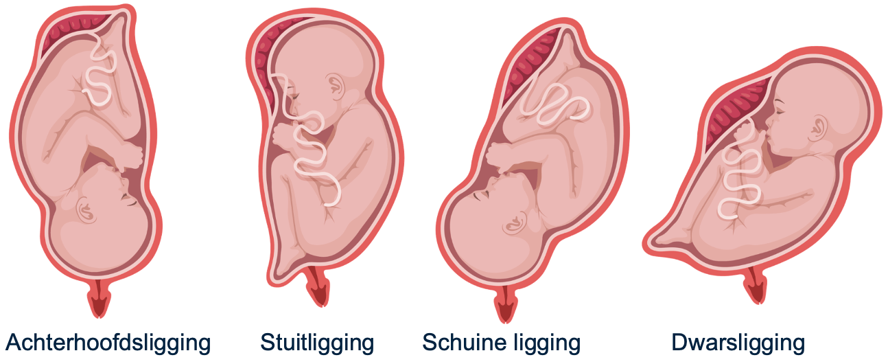 Verschillende posities die de baby in de buik kan hebben. De stuitligging en dwarsligging kunnen tot complicaties leiden bij de geboorte en daarom is er meestal een keizersnede nodig.