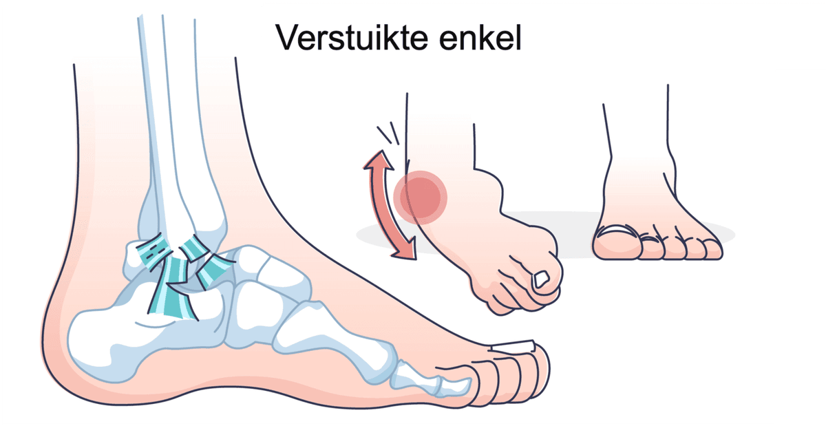 Verstuikte enkel