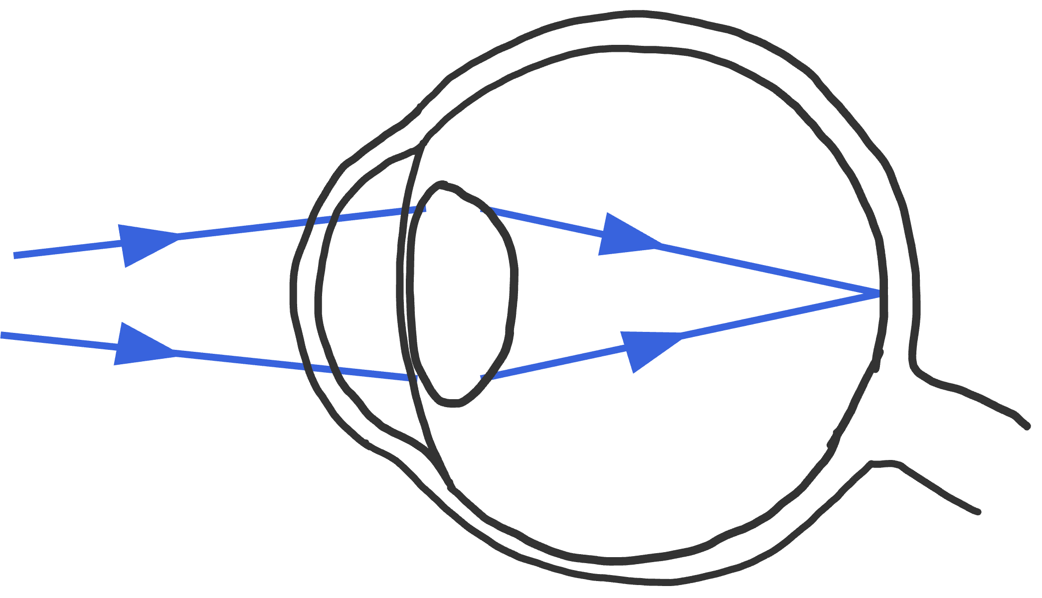 Lichtstralen die schuin het oog binnen komen en door te accomoderen valt het licht scherp op het netvlies. 