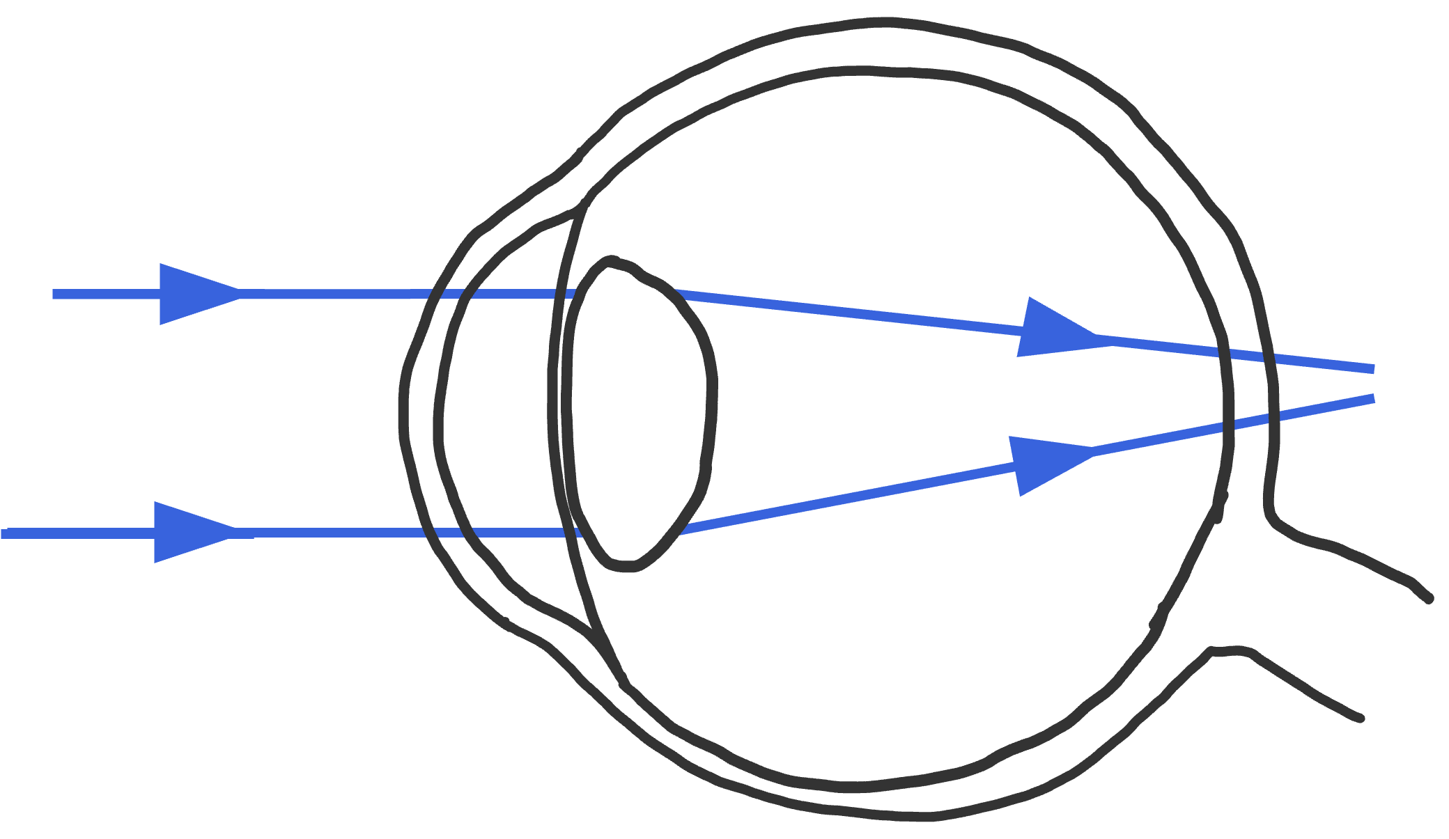 Verziend: de lichtstralen kom achter het netvlies samen.