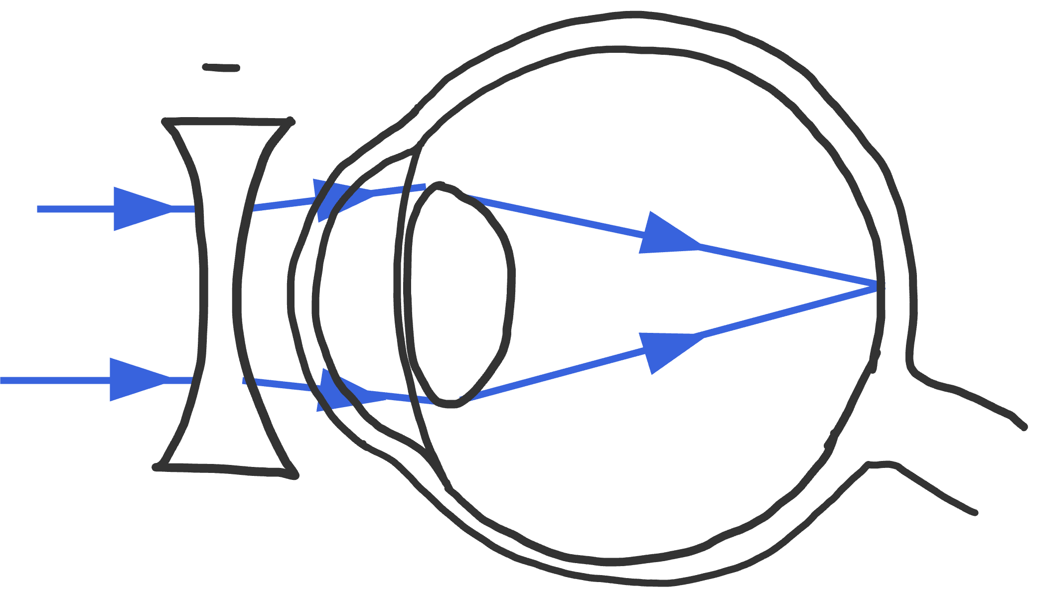 Bijziend met negatieve lens: de lens divergeert de lichtstralen, waardoor ze op het netvlies samen vallen.