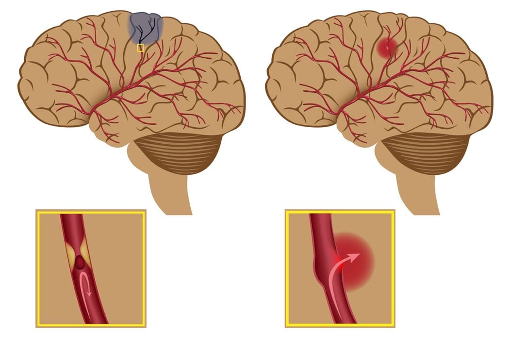 Afbeelding van een normaal brein en een brein tijdens een beroerte