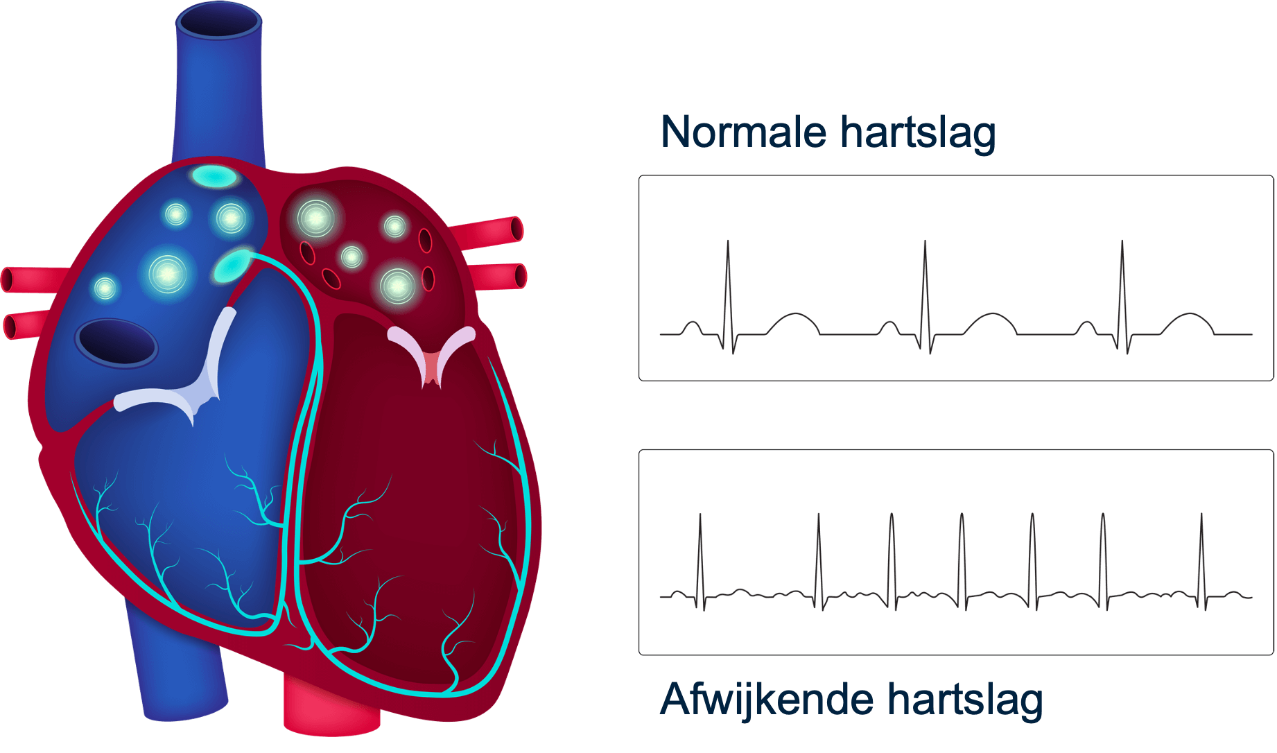 Figuur 3: normale en afwijkende hartslag