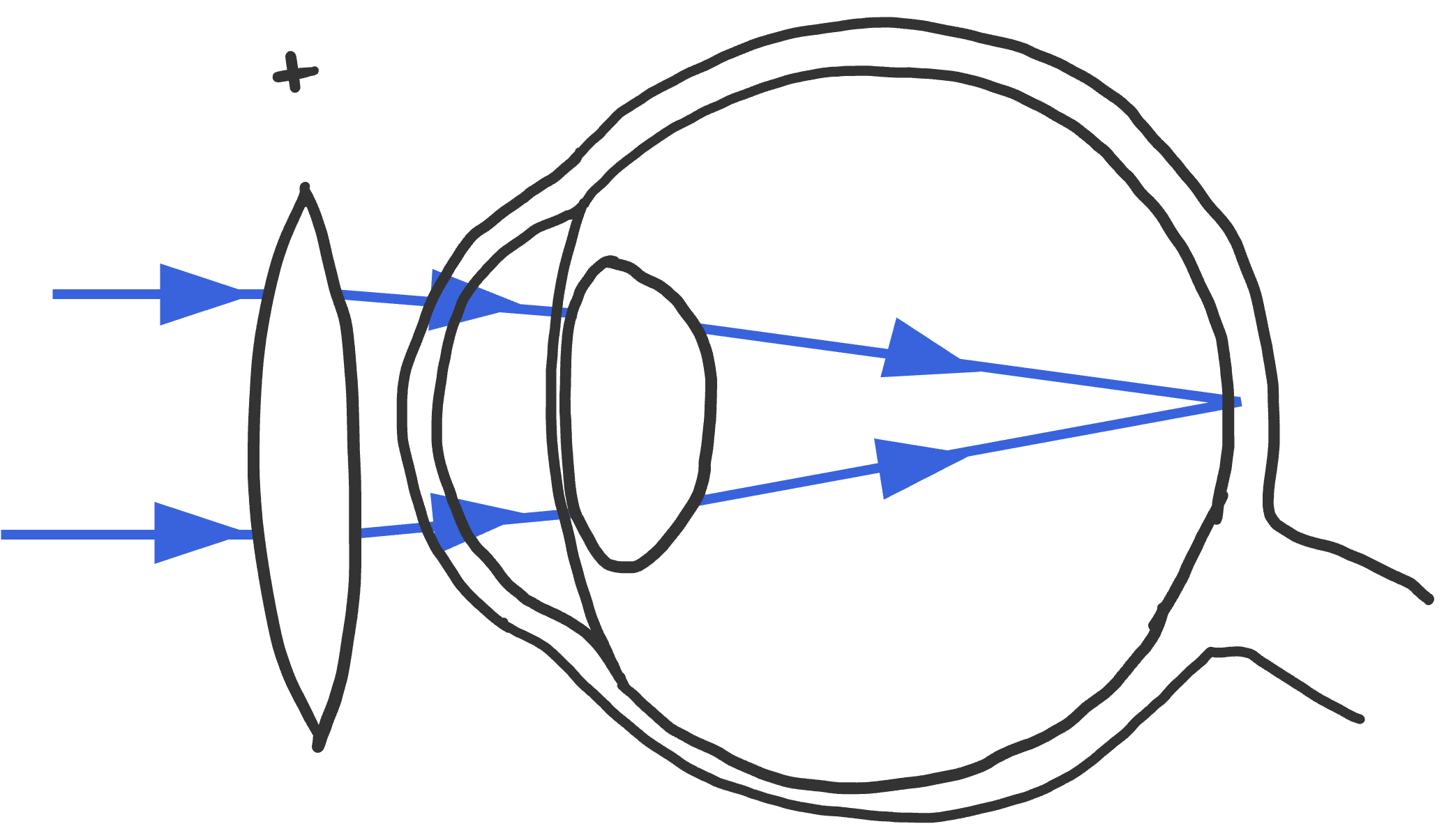 Verziend met positieve lens: de lens convergeert de lichtstralen, waardoor ze op het netvlies samen vallen.