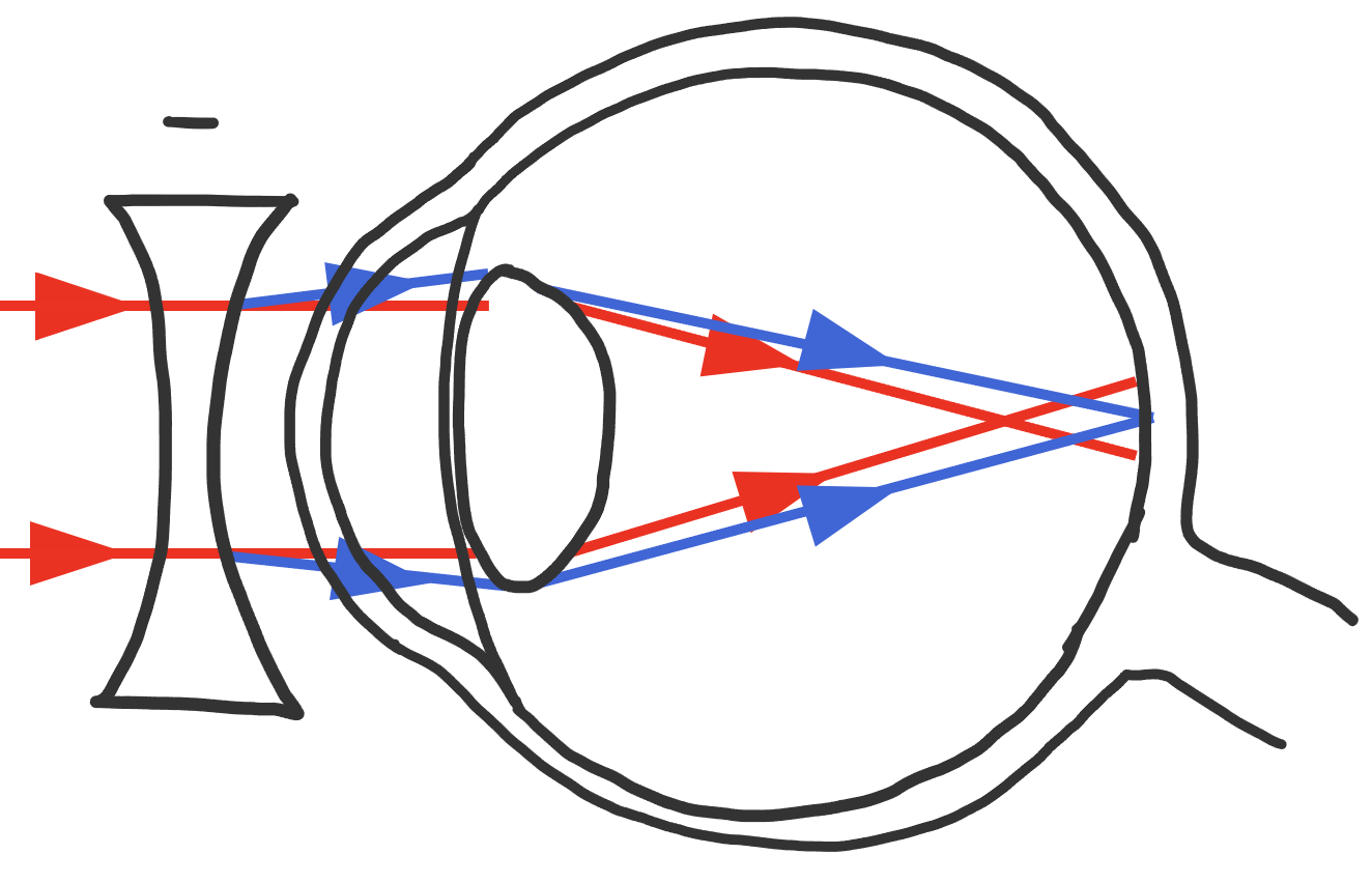 Lichtstralen bij een bijziend oog (convergeren vóór het netvlies in het rood) en de correctie met een negatieve lens (divergeren eerst, dan convergeren op het netvlies in het blauw).