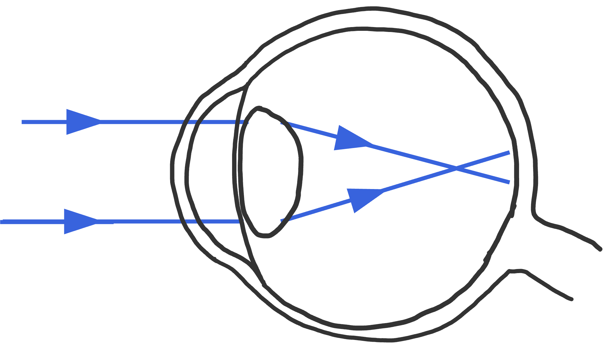 Bijziend: de lichtstralen komen voor het netvlies samen.