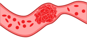 Stolsel in bloedvat blokkeert de bloedbaan (trombose)