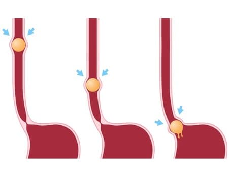 afbeelding van de werking van de darmperistaltiek