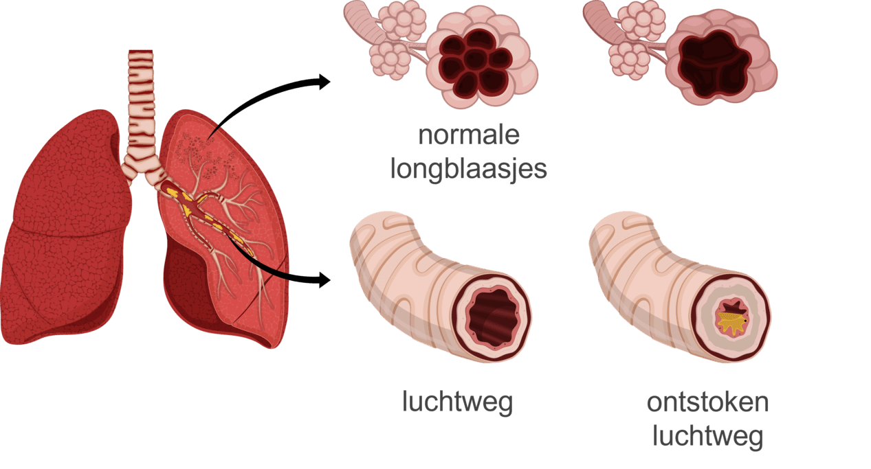 Afbeelding van ontstoken luchtwegen bij COPD