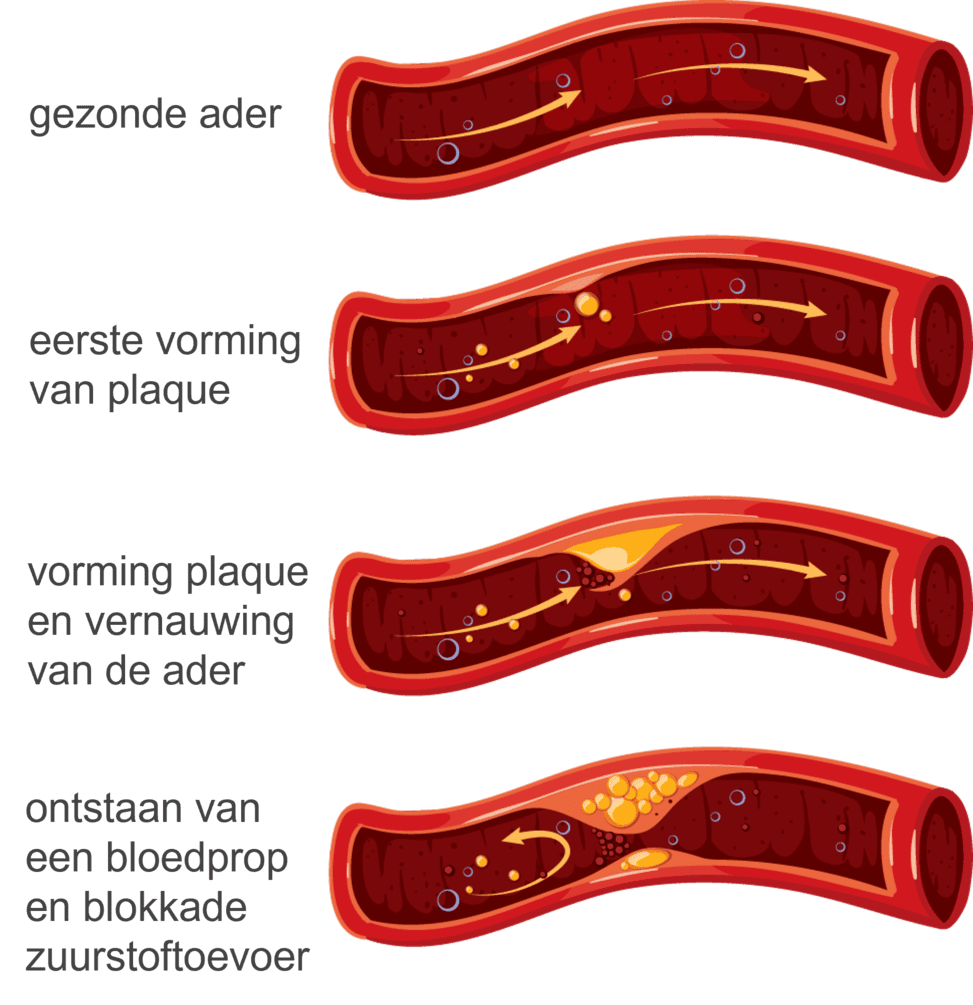 Afbeelding van verstopte slagaders