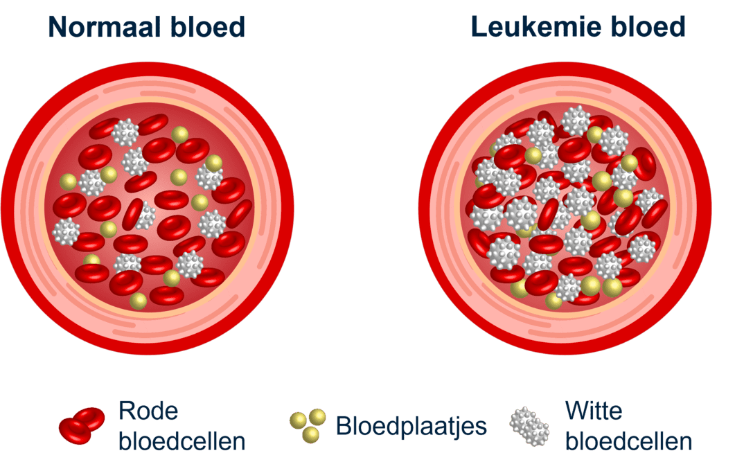 Normaal vs Leukemie bloed
