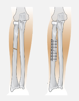 Botbreuk voor en na operatie