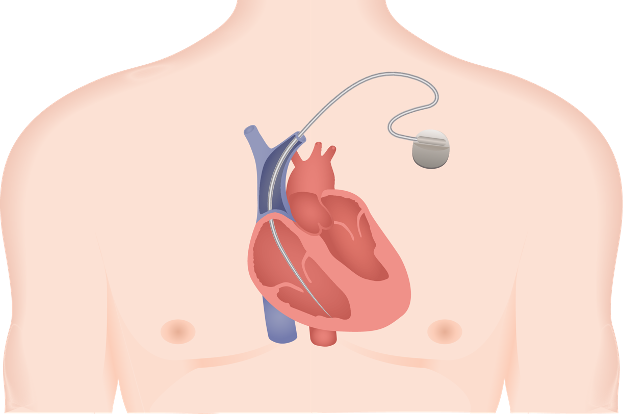 Figuur: hart met pacemaker