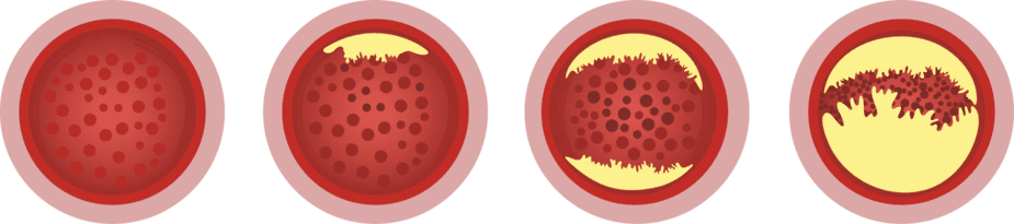 Afbeelding van ophoping van cholesterol waardoor het bloedvat vernauwd wordt.