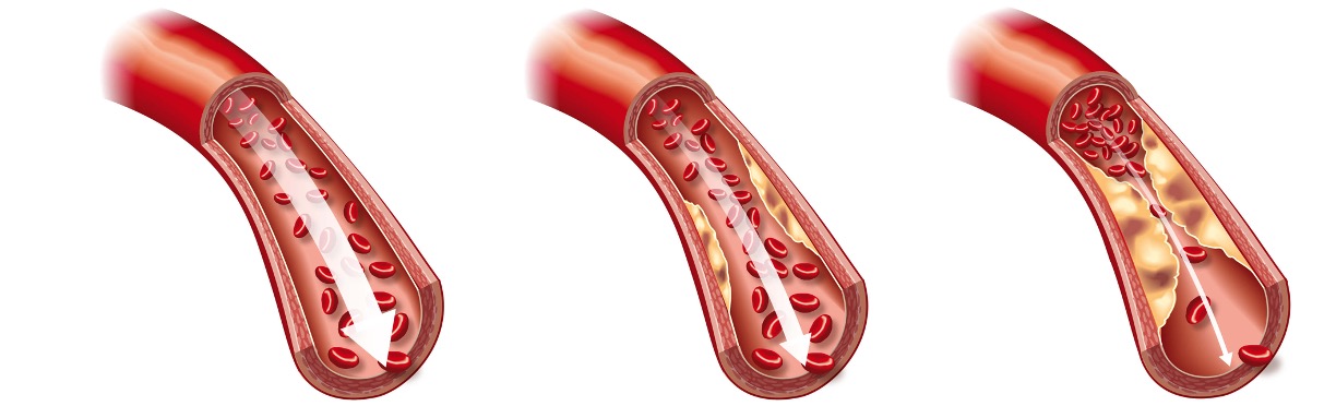 Figuur 1: slagaderverkalking
